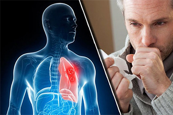 Bên cạnh thuốc lá còn những tác nhân nào gây ung thư phổi?